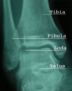 radiographie cheville