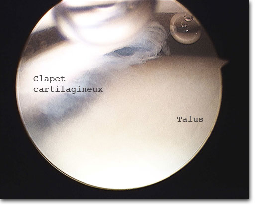 Arthroscopie: clapet cartilagineux du talus
