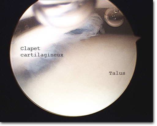 Arthroscopie : clapet cartilagineux du talus