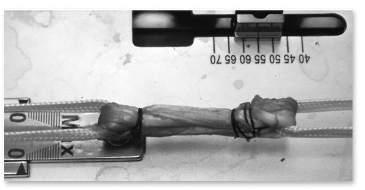 chirurgie ligament croisé antérieur