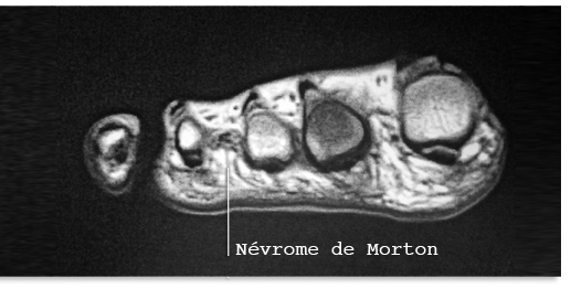 IRM: nvrome de Morton de la 3e commissure