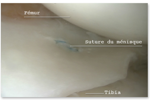 Suture méniscale sous arthroscopie