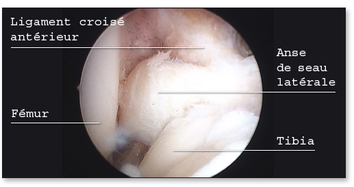 Anse de seau méniscale laterale