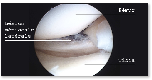 Arthroscopie : lésion méniscale latérale