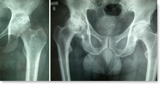 arthrose hanche prothese