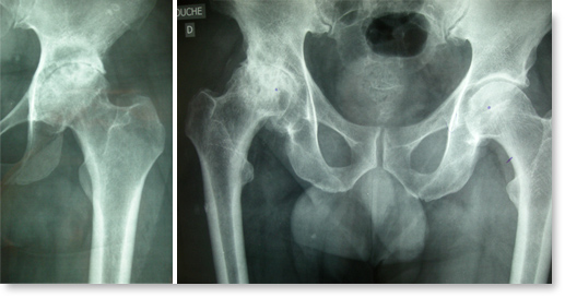 Arthrose de la hanche - Symptômes et traitement de l'arthrose