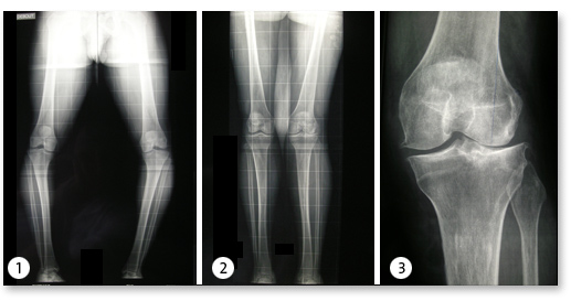 causes arthrose genou