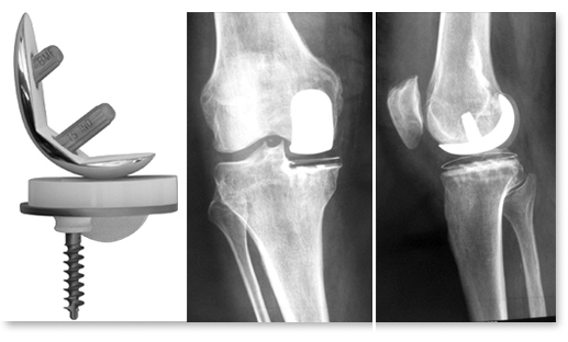 chirurgie prothèse unicompartimentale du genou