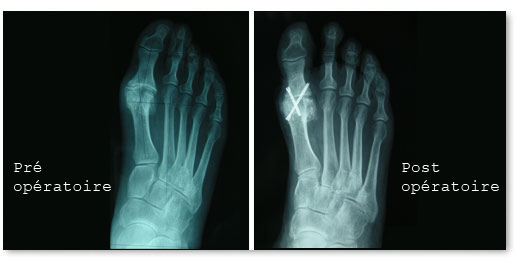 hallux rigidus pre et post operatoire