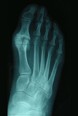 comment soigner un hallux rigidus