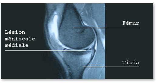 IRM : lésion méniscale médiale