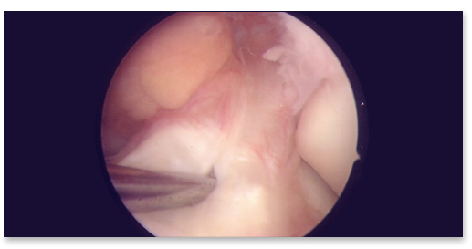 ligament croisé antérieur