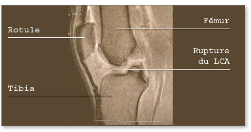 rupture ligament croisé antérieur