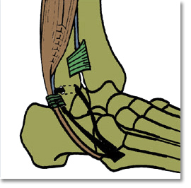 Ligamentoplastie de cheville par hÈmi-Castaing