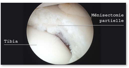 Mènisectomie partielle