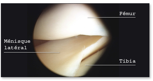 Ménisque latéral sain vu en arthroscopie