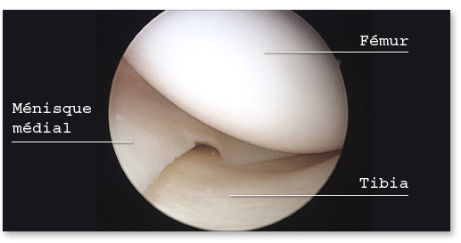 ménisque médial sain vu en arthroscopie