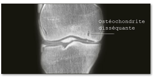 ostèochondrite
