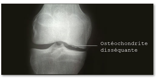 ostèochondrite