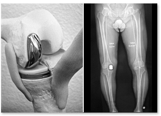 chirurgie prothèse unicompartimentale du genou