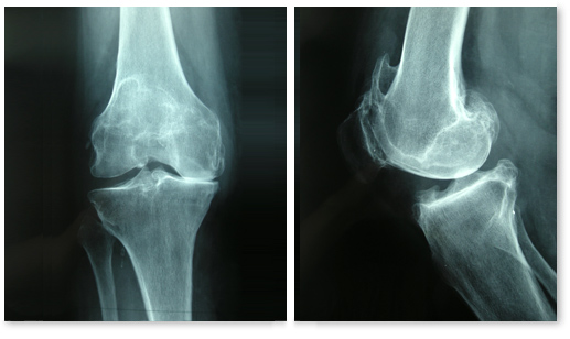 radio arthrose genou