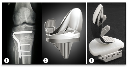 traitement chirurgical arthrose genou